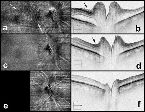 Images of a right eye with NAION: en face images of macula and ONH ...