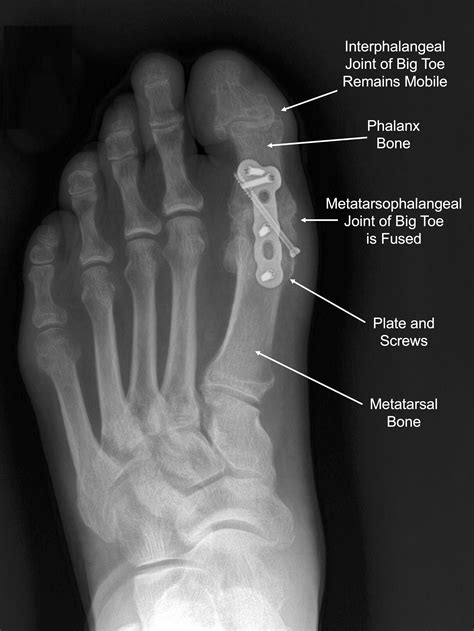 Big Toe Arthritis — Daniel Bohl, MD | Midwest Orthopaedics at RUSH