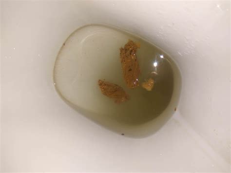 Great Brown Mucus In Stool Check it out now | stoolz