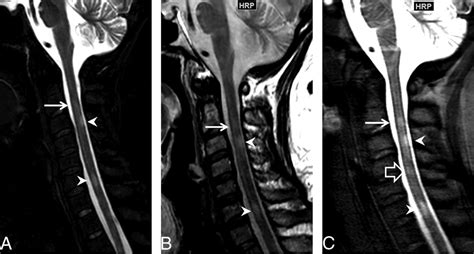 Cervical Spine Mri Ms