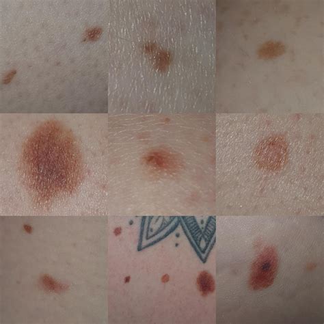 Dysplastic nevus? : r/Melanoma