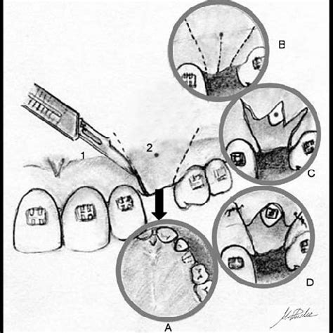 1: Mucogingival junction. 2: Ink mark. A: Palatal prolongation of the... | Download Scientific ...