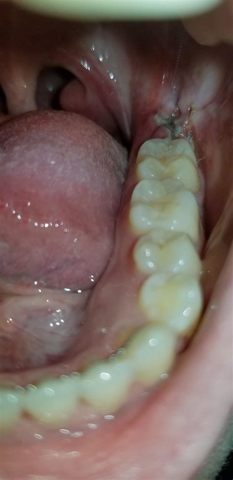 Does this look like dry socket? : r/wisdomteeth