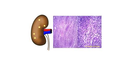 Pathology of Acute pyelonephritis - Pathology Made Simple