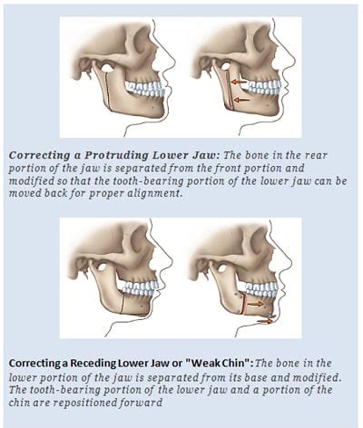 Jaw Surgery | Leesburg | Orthognathic Surgery | Misaligned Jaws