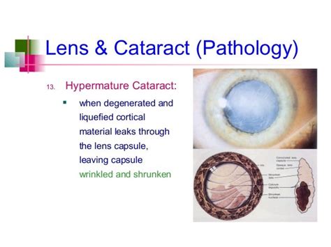 Age related Cataract