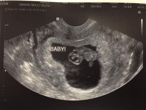 What Does A Baby Look Like At 8 Weeks Ultrasound - Baby Viewer