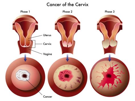 Cervical Cancer Symptoms and Signs | Cervical Cancer Prevention