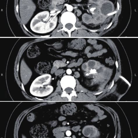 Enhanced CT images of the left calculous pyonephrosis after ...