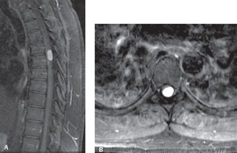 Spinal Cancer Mri - CancerWalls