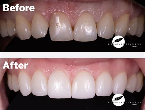 Veneers Before and After By Dr Kasen