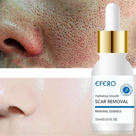 EFERO Shrink Pores Treatment Essence Face Serum Nose Blackhead Remover Acne Treatment Face Serum ...