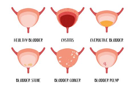 Symptoms Of Cystitis Bladder