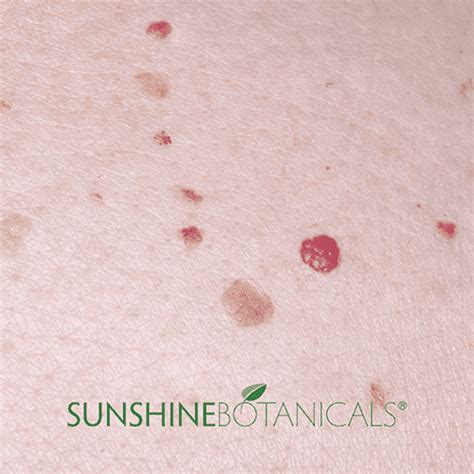 Cherry Angiomas | Sunshine Botanicals