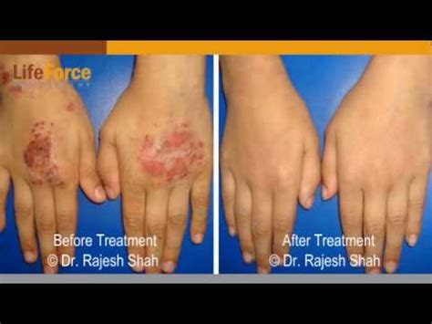 Eczema Before And After