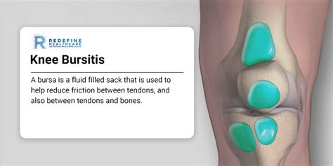 Knee Bursitis - NJ's Top Orthopedic Spine & Pain Management Center