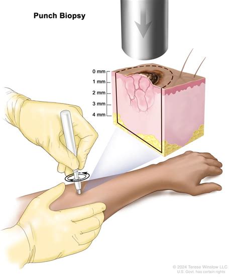 Skin Cancer | Vanderbilt-Ingram Cancer Center