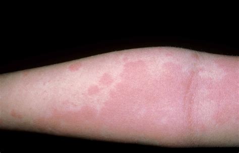 Urticaria; rash on arm | Food allergy symptoms, Common food allergies, Common skin rashes