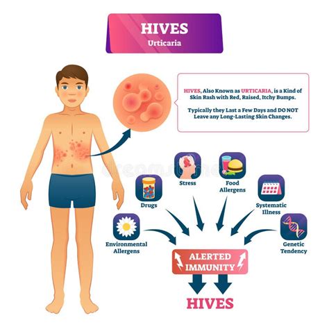 Urticaria Hives