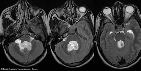 Dr Balaji Anvekar FRCR: Intraventricular Arachnoid cyst MRI