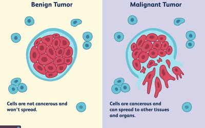 Neoplasm Types and Factors That Cause Them