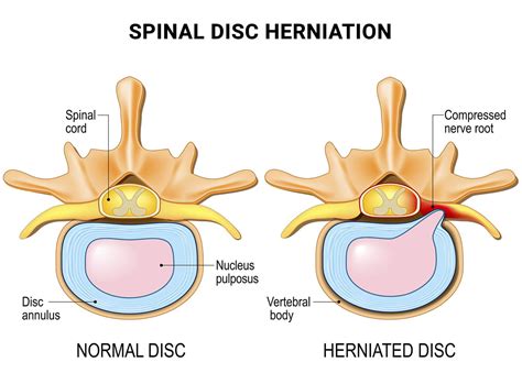 What Are The Symptoms Of A C5-C6 Bulging Disc?