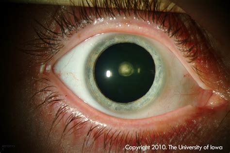 Posterior Polar Cataract. EyeRounds.org - Ophthalmology - The ...