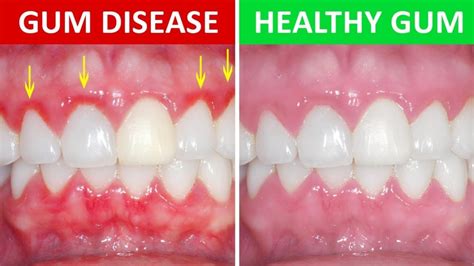 The most common causes of gum disease - Regency Dental