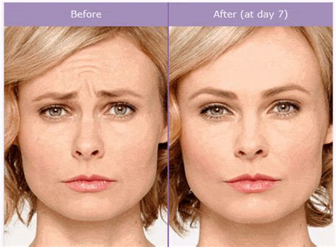 Botox Before and After Pictures Jersey City, Newark, NJ