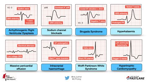 Interpretation Cheat Sheet Ecg Abnormalities Chart