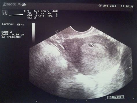 3 Weeks Pregnant - Signs, Symptoms and Embryo