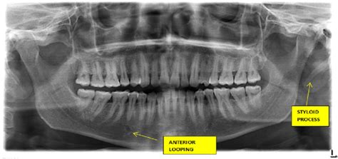 OPG showing styloid process and anterior looping. | Download Scientific ...