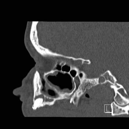 Periapical cyst | Radiology Reference Article | Radiopaedia.org