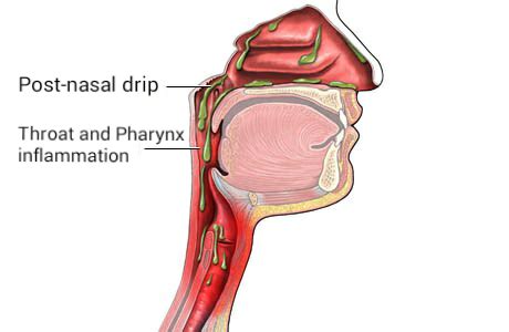 Post-nasal drip - Wikiwand