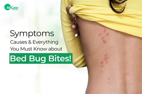 Bed Bug Bites Characteristics Causes Treatment – NBKomputer