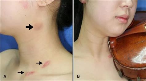 How to Prevent or Even Cure a Violin Hickey | Strings Magazine