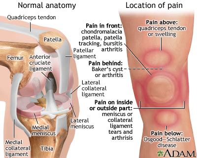 Knee pain Information | Mount Sinai - New York