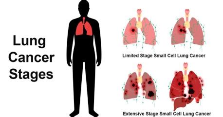 Limited vs. Extensive Stage Small Cell Lung Cancer | BIS Research News