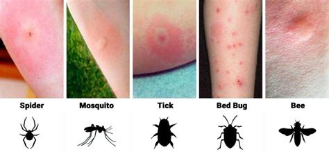 Bed Bug Bite Symptoms - wall mounted bunk ca