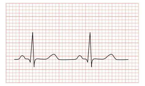 File:Normal ECG 2.svg