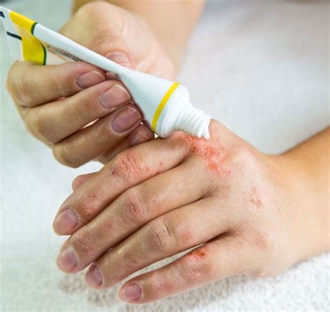 Eczema: Skin treatment - what is the best for rash? Tips include cream | Express.co.uk