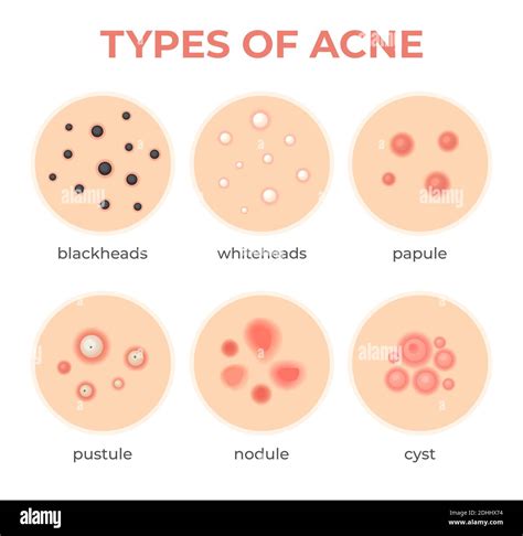 Cyst acne Stock Vector Images - Alamy