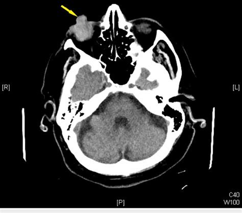 Figure 2 from Globe Rupture and Protrusion of Intraocular Contents from Fall in Elderly Patient ...