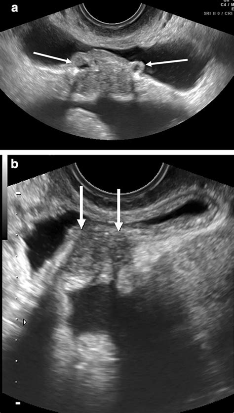 Bladder endometriosis. a Axial and b sagittal transvaginal sonography ...