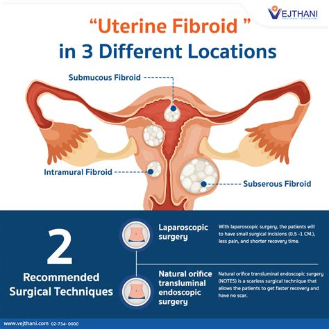 The Difference of Uterine Fibroid in 3 Different Locations