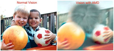 Macular Degeneration, Everything You Need To Know