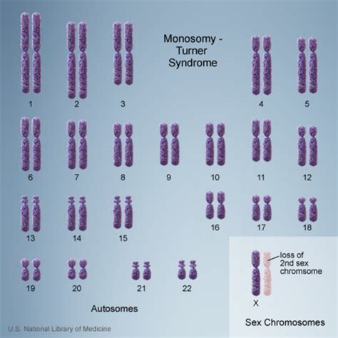 Turner syndrome: MedlinePlus Genetics