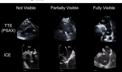 Figure 2 from Visibility of Pulmonary Valve and Pulmonary Regurgitation on Intracardiac ...