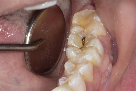 cracked tooth1 – Berwyn Dental Connection