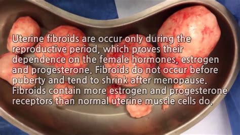 Uterine Fibroids: Innovative 100% natural treatment without surgery ...